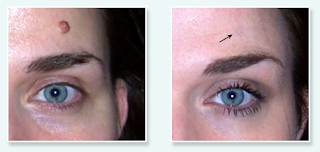 mole removal before and after