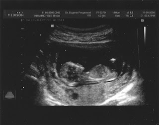 Nov 5 ultrasound