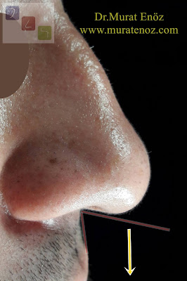 Droopy or Ptotic Nasal Tip