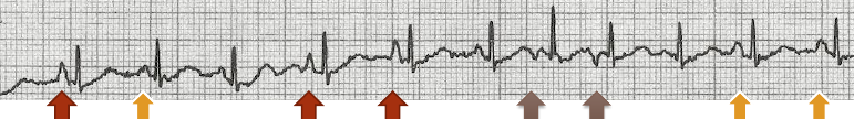 multifokal-atriyal-tasikardi-ekg-degerlendirme-1