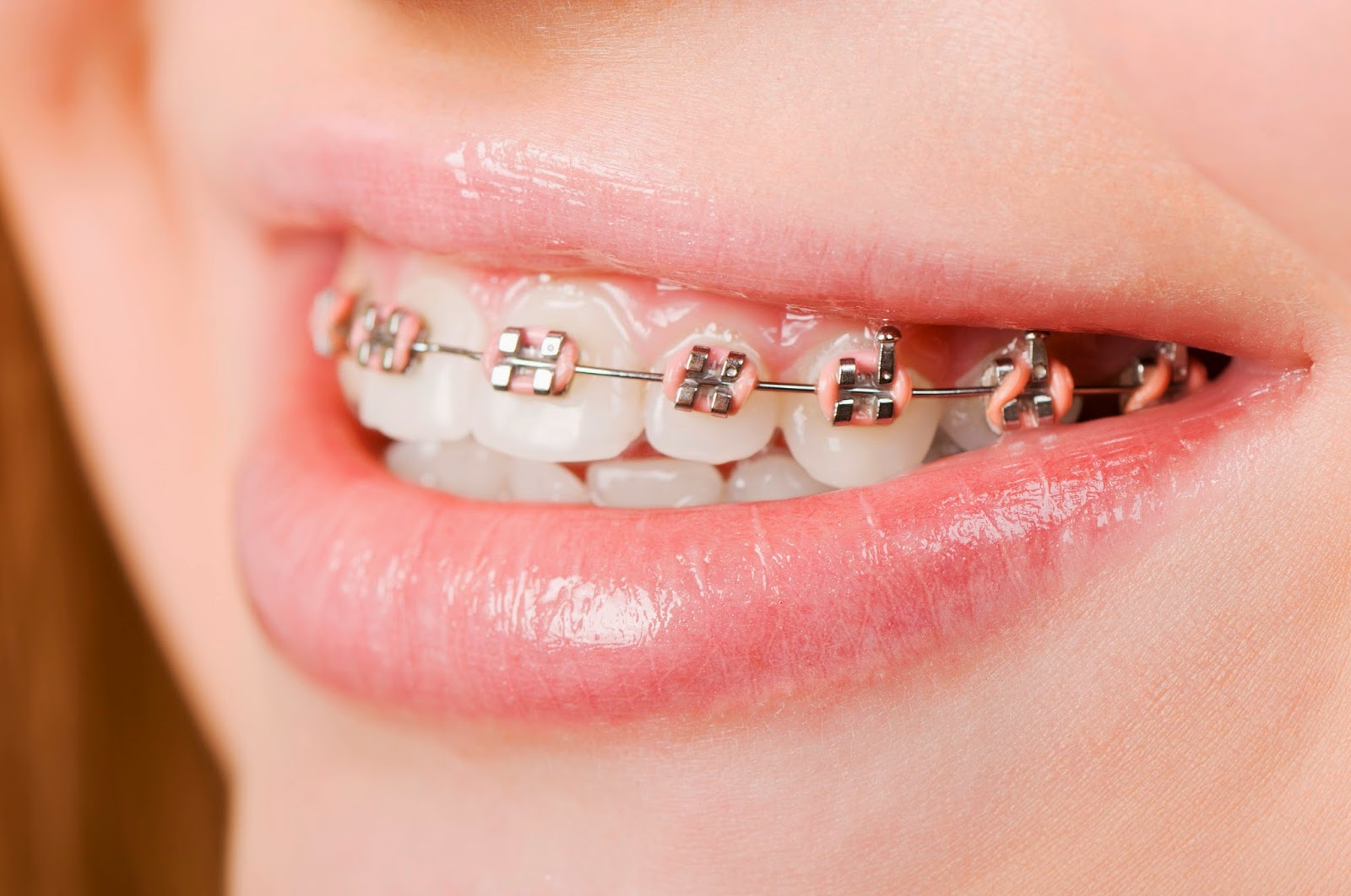 metal braces