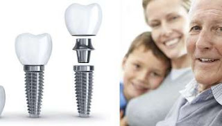Dental Implant in Athens TN