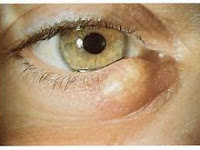 Chalazion: Gambar, penyebab, dan perawatan