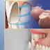 Bọc răng sứ cao cấp có lợi ích gì? 