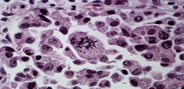 Gambar Sel Kanker Diamati Pada Mikroskop