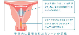 ミレーナ説明　子宮内膜症の症状・原因・治療方法