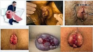 Obat Ambeien Pada Ibu Menyusui