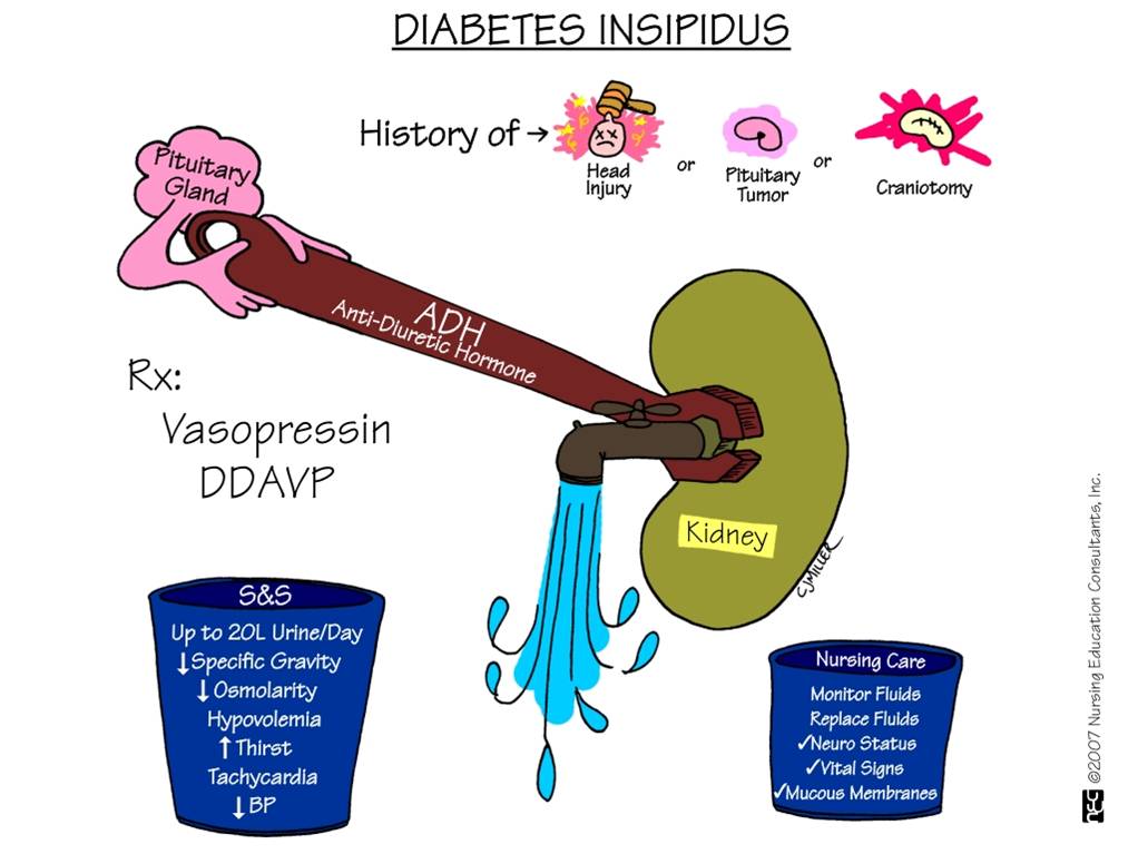 Diabetes Insipidus Nursing