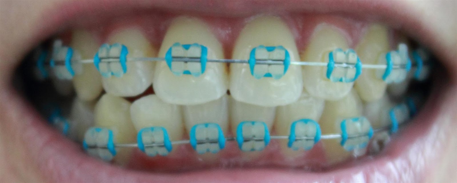 Clear braces with blue bands (Braces update) -