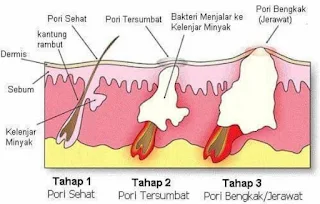 Bopeng Bekas Jerawat Bagaimana Cara Menghilangkannya