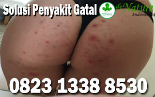 https://obatkhususgatal.blogspot.com/2019/08/obat-pantat-gatal-bentol-bentol.html