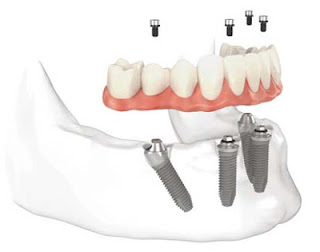 Dental implants Chicago