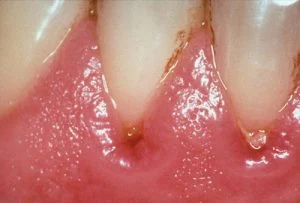 Dấu hiệu nhận biết viêm chân răng