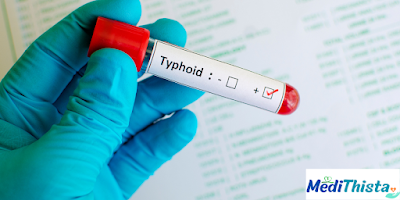 Understanding Typhoid: Causes, Symptoms, and Treatment