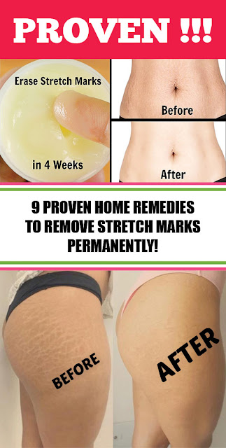 9 Proven Home Remedies to Remove Stretch Marks Permanently!