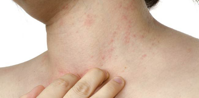 Skin Diseases : चर्म रोग क्या है | यह कितने प्रकर का होता है | इसके लक्षण और उपाय व दवा, सब जानें विस्तार से 