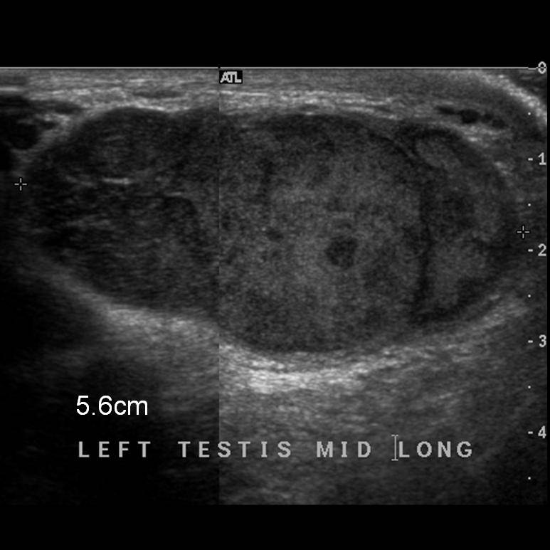  in patients electing not to have an orchiectomy for an early lesion