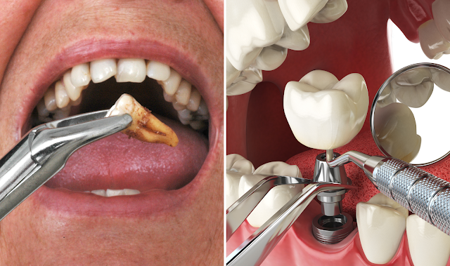 Tooth Extraction and Surgical Extraction