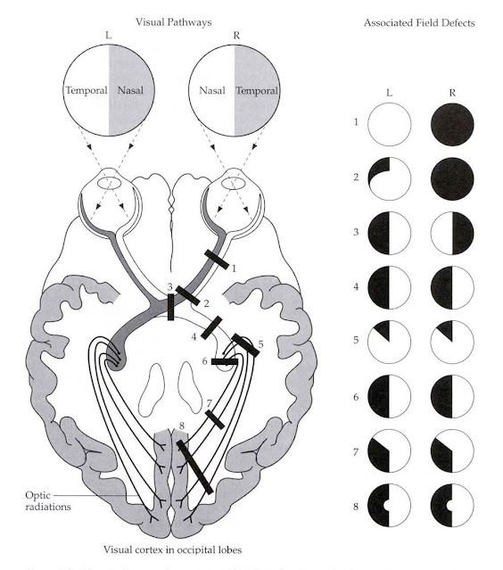 Visual Field Defects By Stroke Location