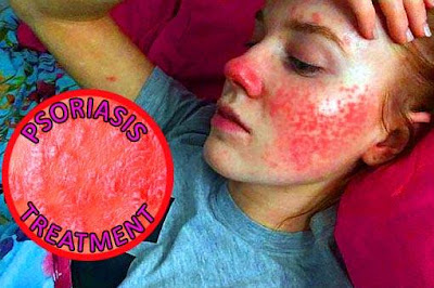 The Best Natural Psoriasis Treatment