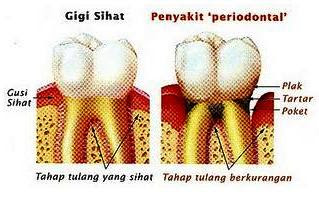 PERUBATAN Cawangan Mansurah: Periodontal Disease : Menjaga 