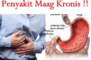 Penyakit Maag Kronis 