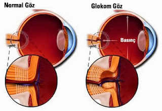 Göz tansiyonu hastalığı , göz tansiyonu belirtileri ve tedavisi