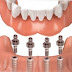 Kỹ thuật trồng răng implant