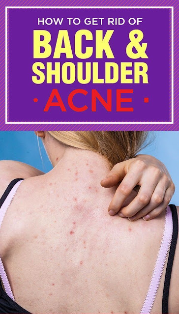 3 Best Remedies For Back Acne