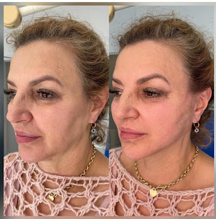PRP Treatment for the face