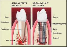 Teeth In A Day