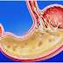 37 Ways to Overcome High Gastric Acid Naturally