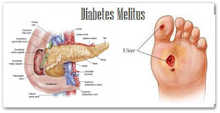 cara mengobati penyakit diabetes