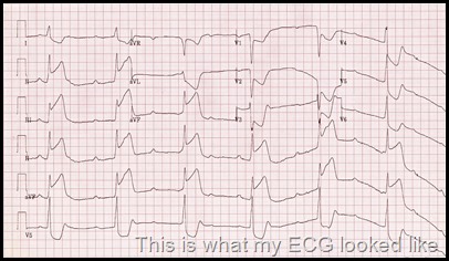 inf-STEMI-CHB