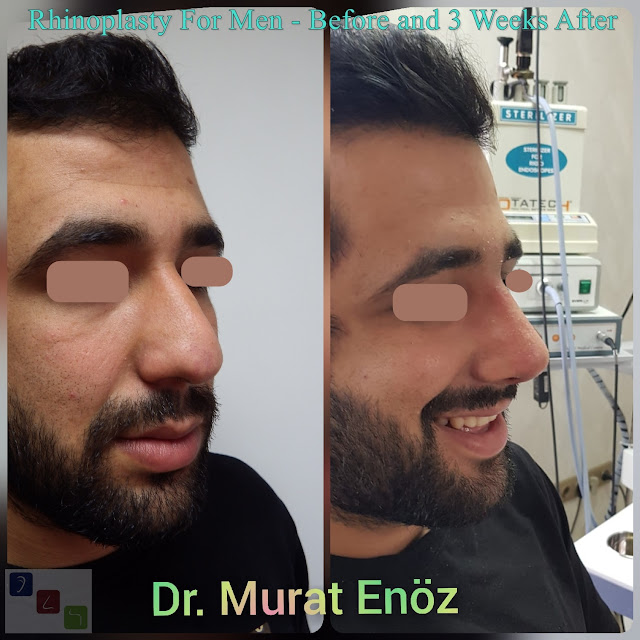 Rhinoplasty For Men - Before and 3 Weeks After - Male Nose Job Turkey