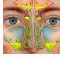 Ineffective Airway Clearance related to Rhinosinusitis