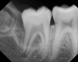 Kista Periodontal Lateral