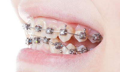 Niềng răng chỉnh móm hiệu quả cao khi nào? 2