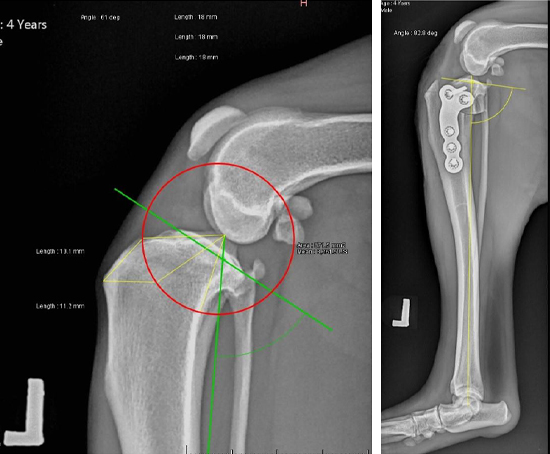 前十字韌帶傷害，導致脛骨平台位移（左圖術前）。經手術治療改變脛骨關節面的角度（右圖術後）。