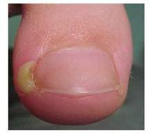 ingrown toenail