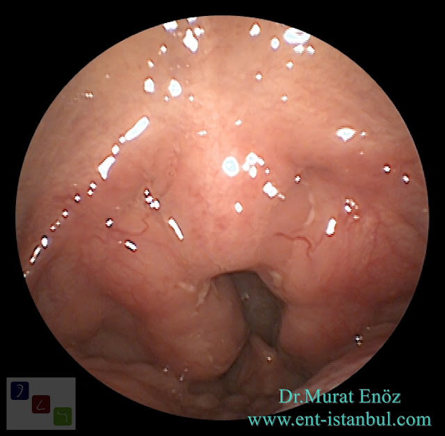 Enlarged Tonsils (Tonsillar Hypertrophy)