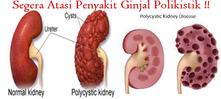 Obat Tradisional Ginjal Polikistik