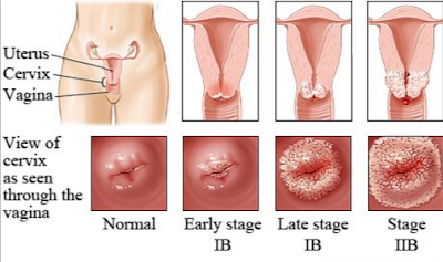 Gejala Kanker Serviks
