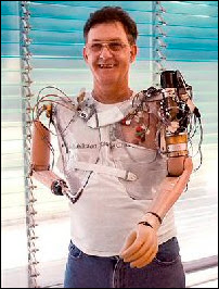 Jesse Sullivan portant la première génération de prothèse bionique fabriquée notamment par l'APL.