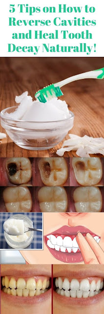 5 TIPS ON HOW TO REVERSE CAVITIES AND HEAL TOOTH DECAY NATURALLY!