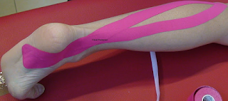 Tendinite e o Kinesio Taping