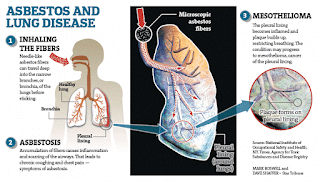 Asbestos lung disease