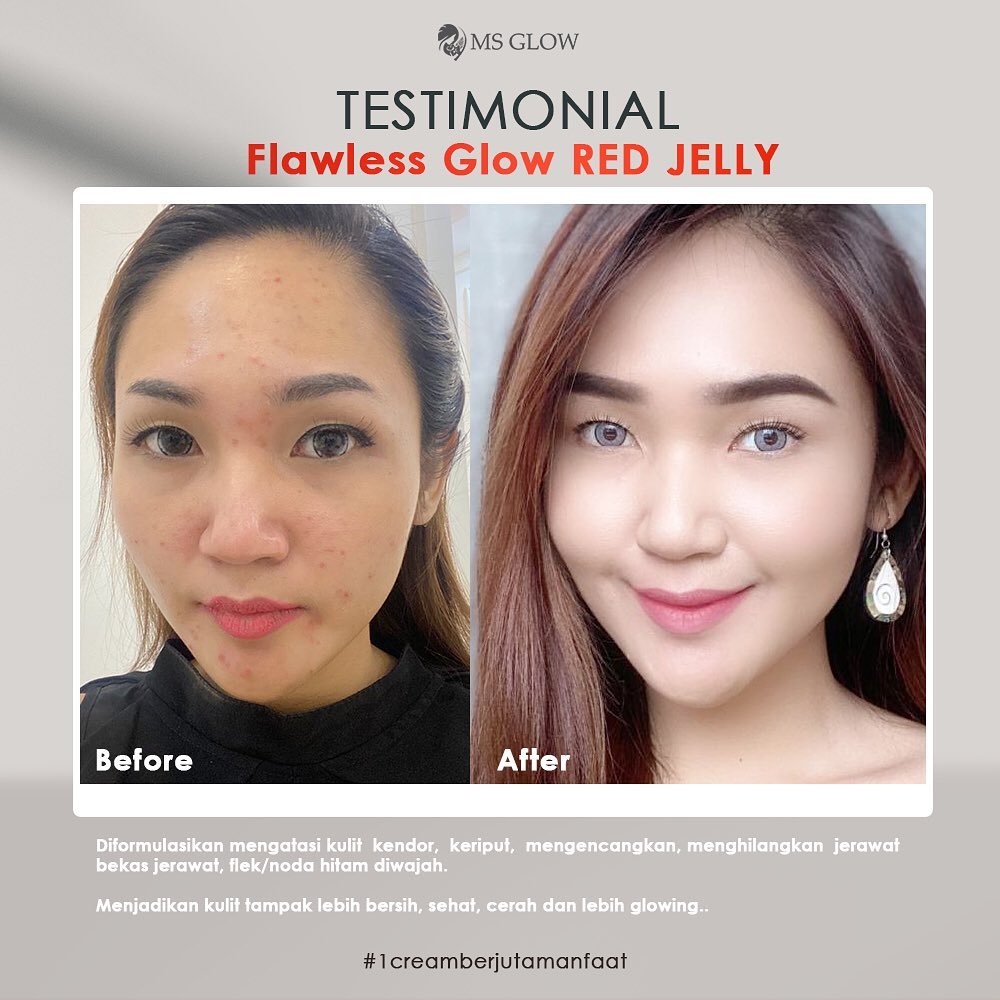 Distributor Cream Komedo Ms Glow Terbaik Di Bali