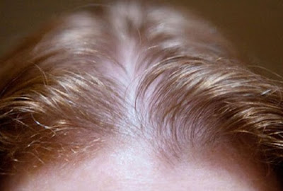 Biểu hiện mất tóc của phụ nữ một phần như nam giới