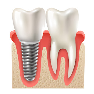 dental implants treatment in Gurgaon